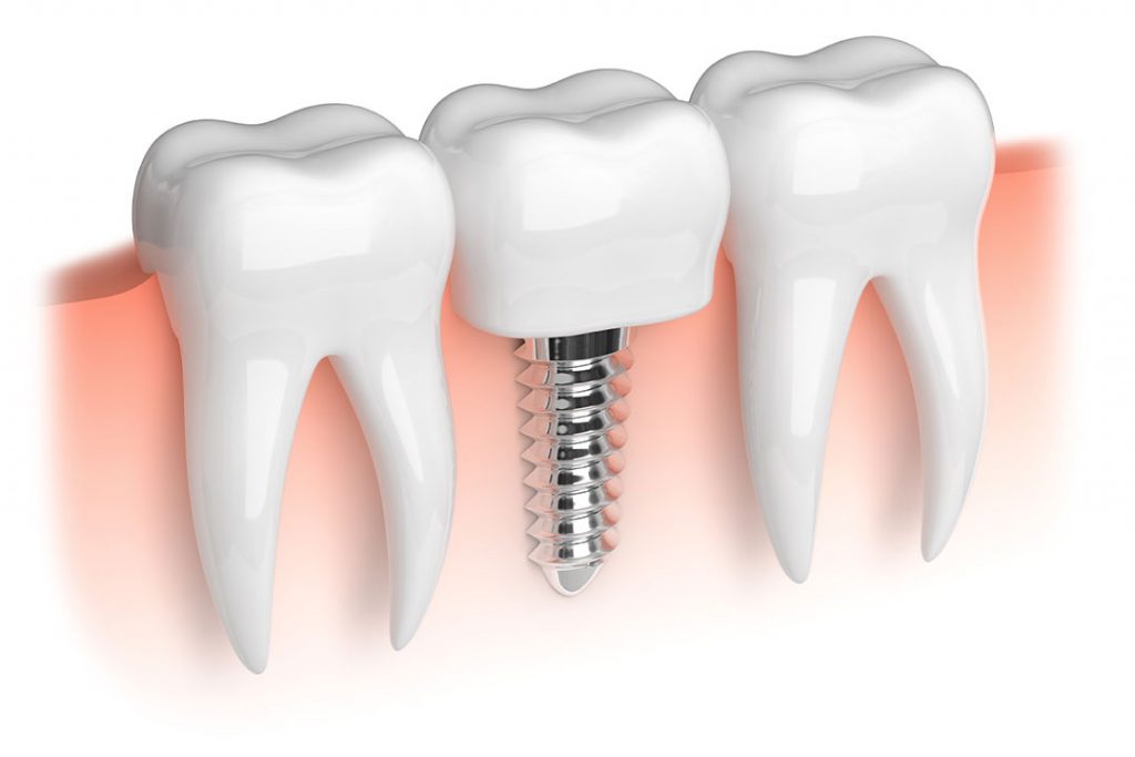 Darstellung Implantat zwischen zwei Molaren