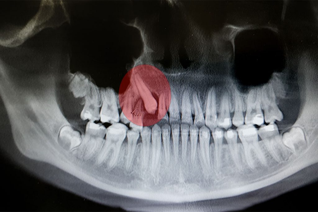 Röntgenbild mit verlangerten Zahn