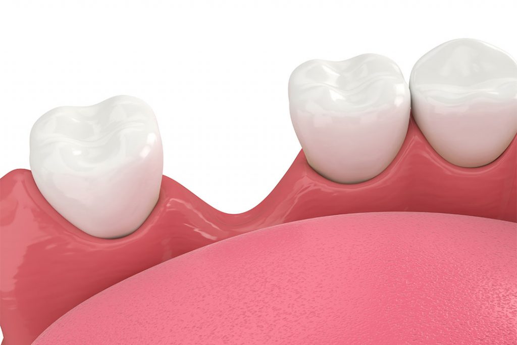 Zahnlücke mit Knochenabbau