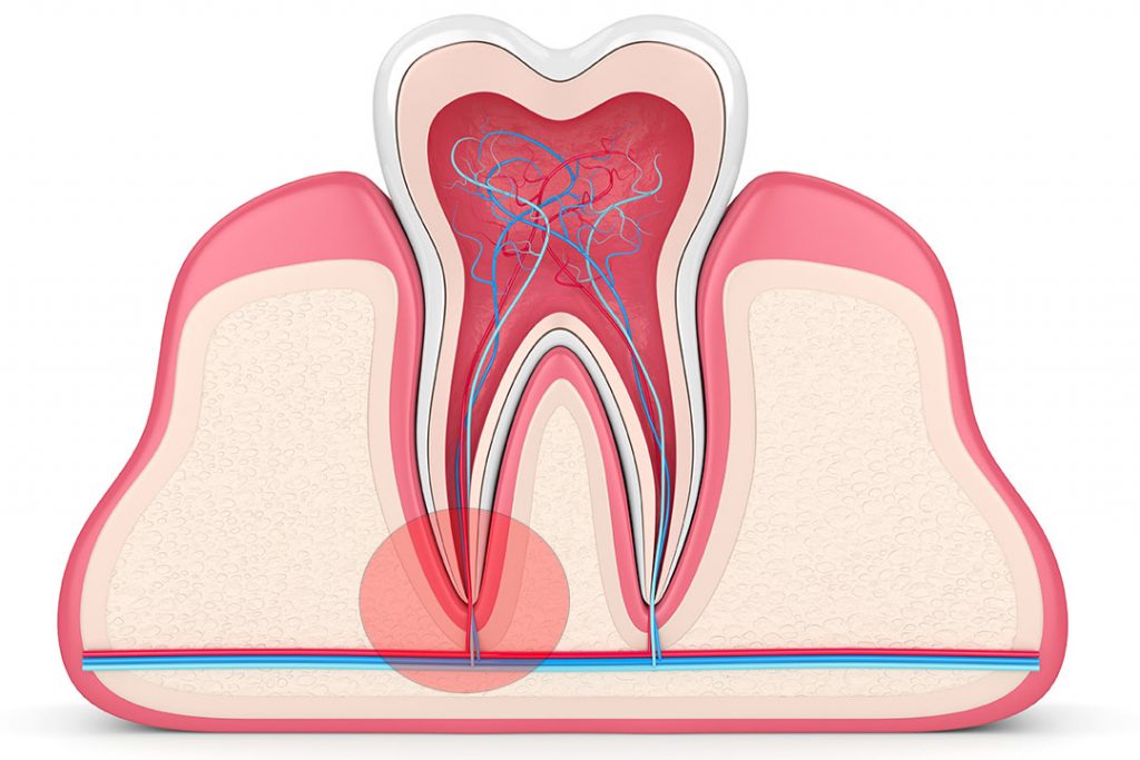 Zahn mit eingezeichneter Wurzelspitze