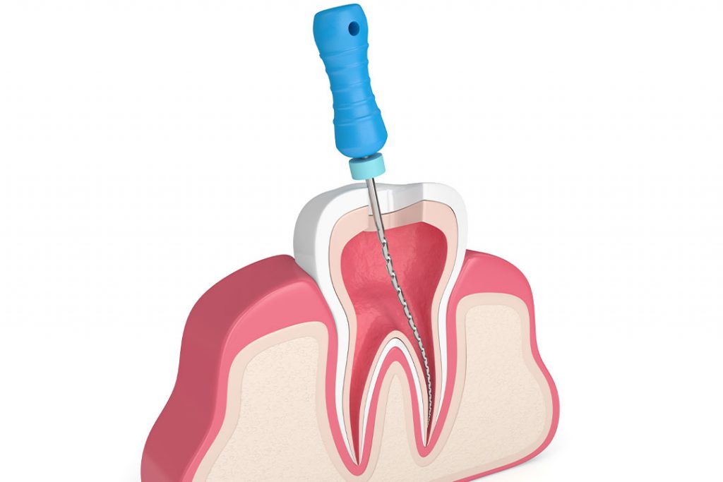 Darstellung Feile im Wurzelkanal