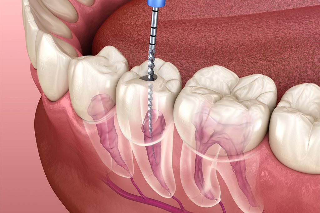 Darstellung einer Wurzelkanalbehandlung