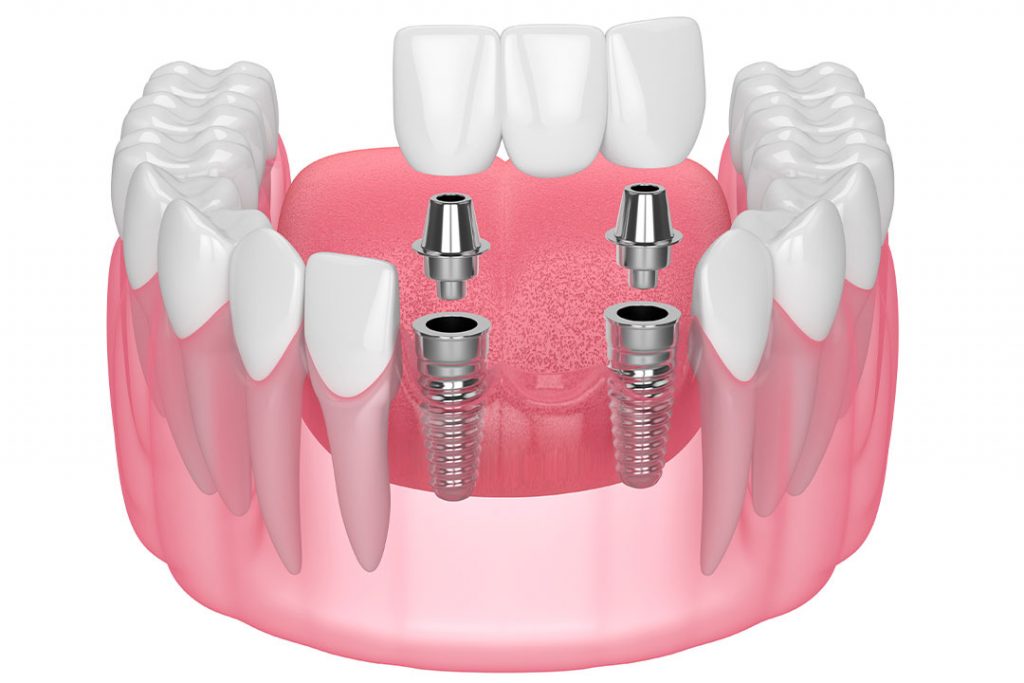 Implantatgetragene Brücke im Frontzahnbereich