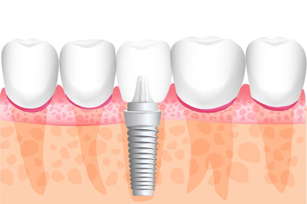 Darstellung Kermaikimplantat