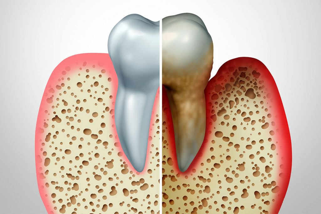Zahn mit Entzündung