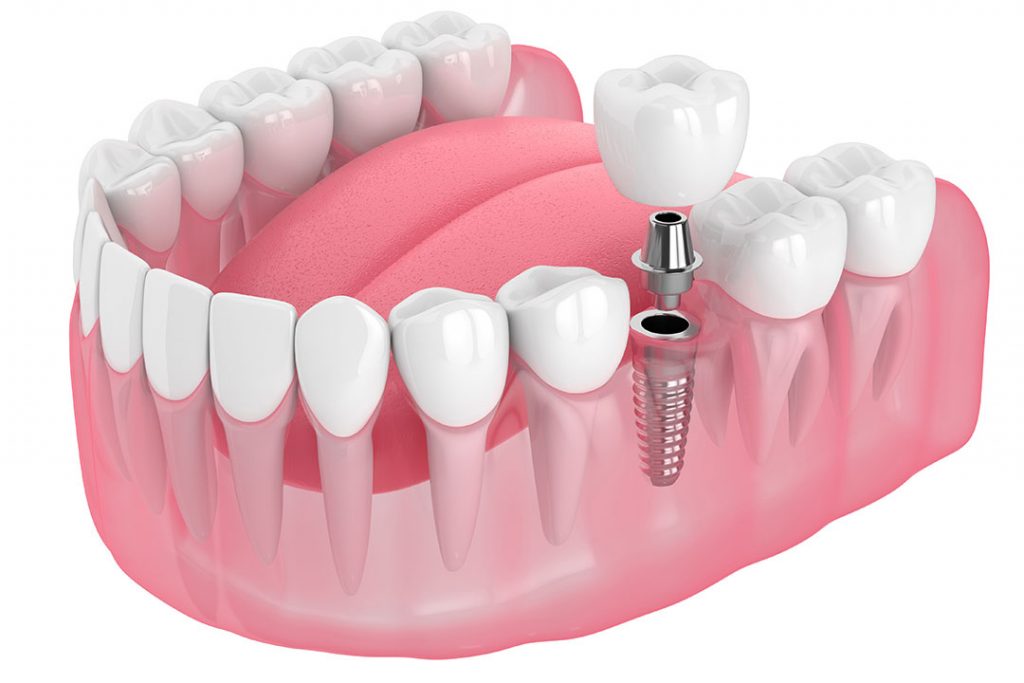 3D-Darstellung Sofortimplantat