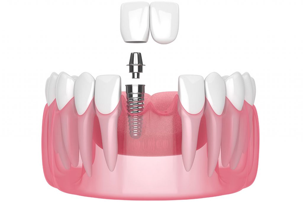 Implantat nach Knochenaufbau