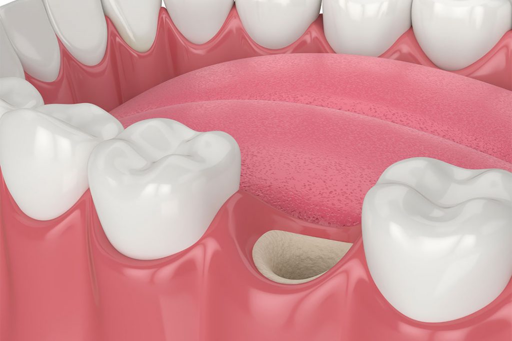 Knochentransplantation