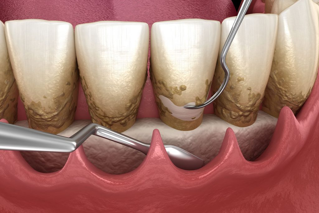 Chirurgische Parodontitisbehandlung im Frontzahnbereich