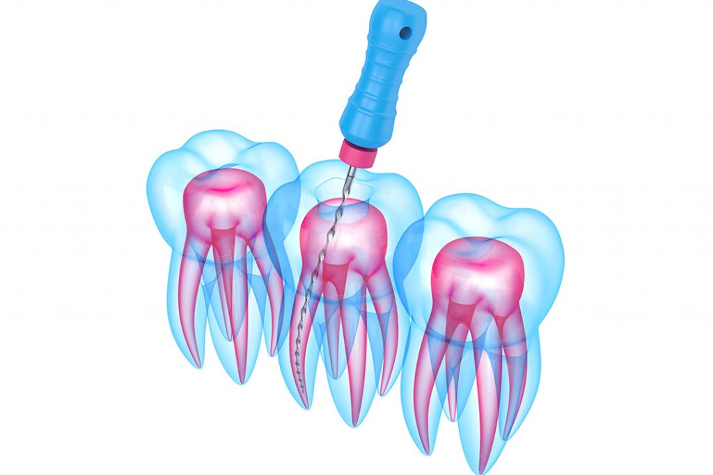 Mehrere Zähne mit Feile