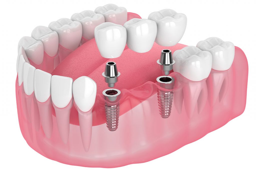 Implantatgetragene Brücken Bayerwaldzahn MVZ GmbH