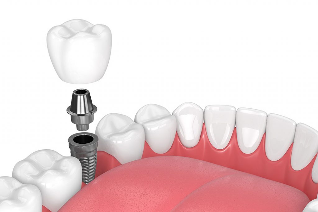 Hemisektion - Nach Entfernung kann die Lücke mit einem Implantat geschlossen werden