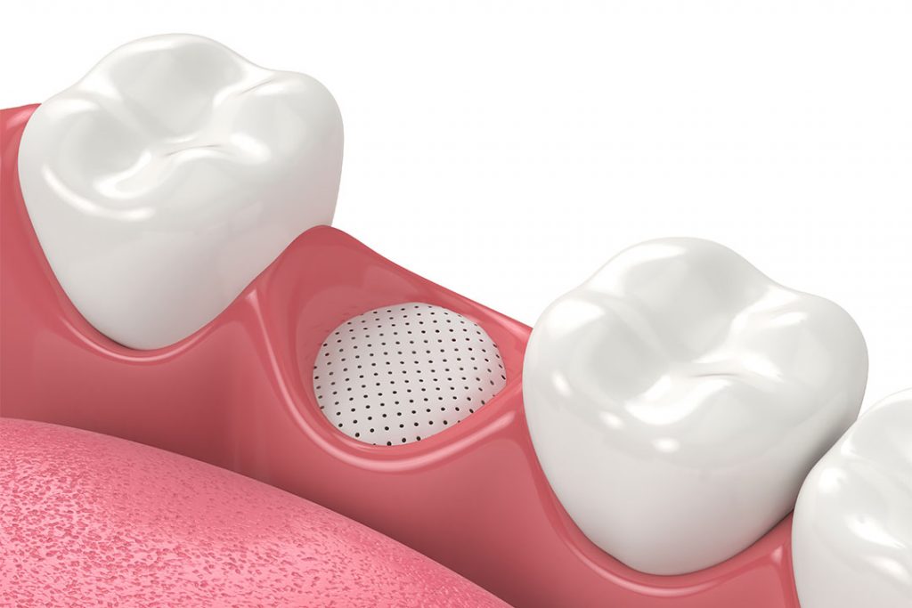 Abgeschlossene Knochentransplantation