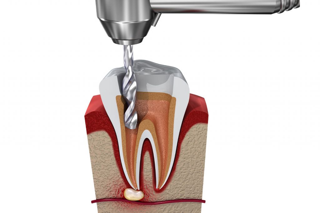 Wurzelkanäle werden mittels Bohrer geöffnet