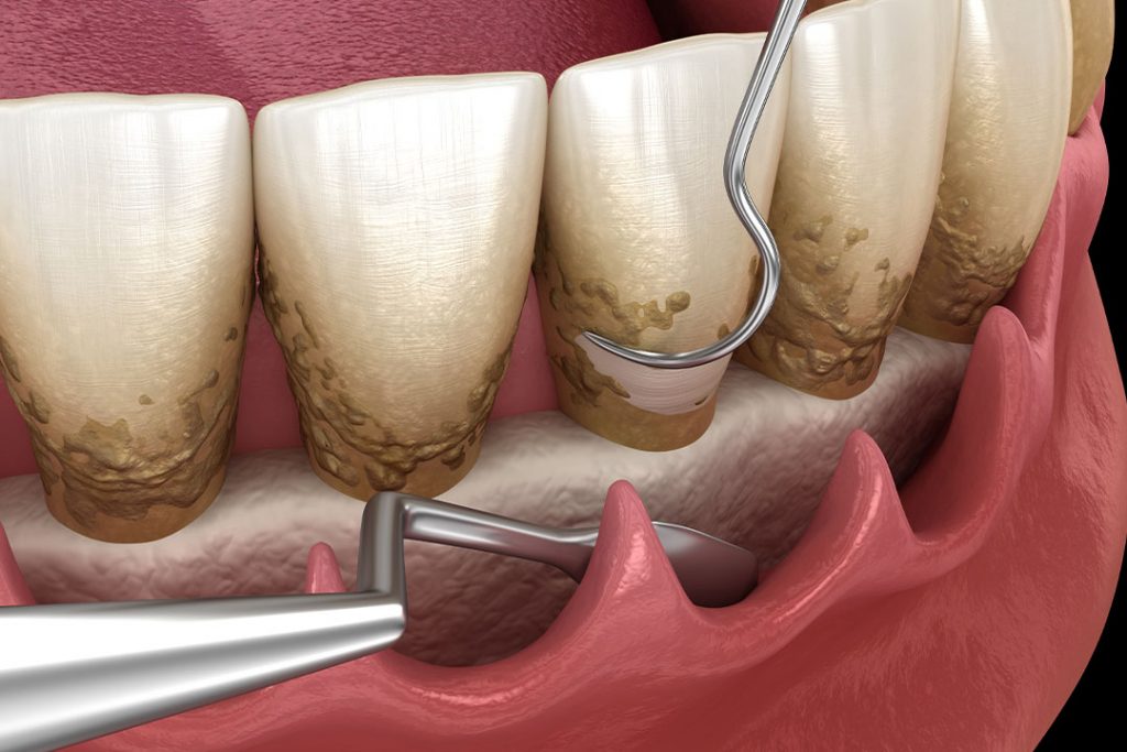 Offene Parodontitisbehandlung