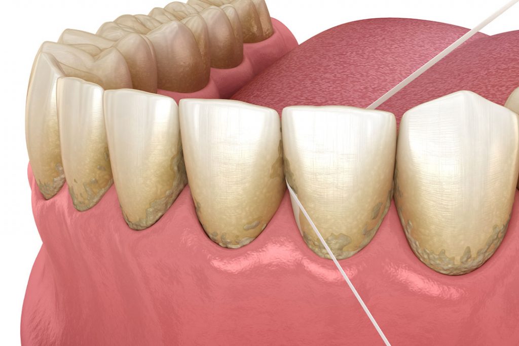 Nachsorge Parodontitis