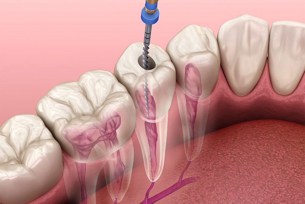 Darstellung Wurzelkanalfüllung