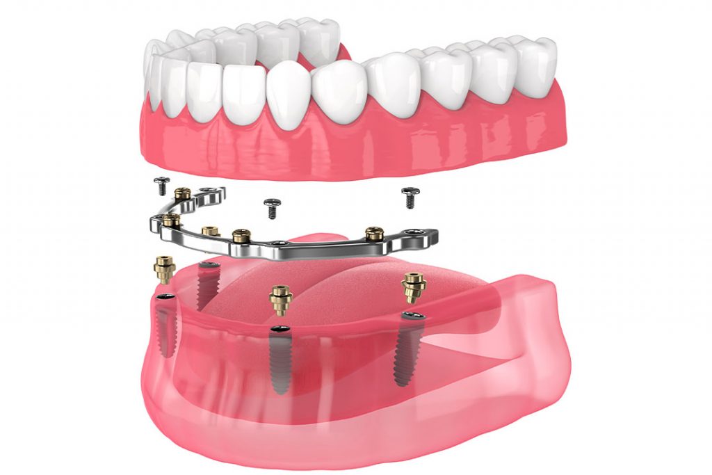 Vollprothese auf Steg