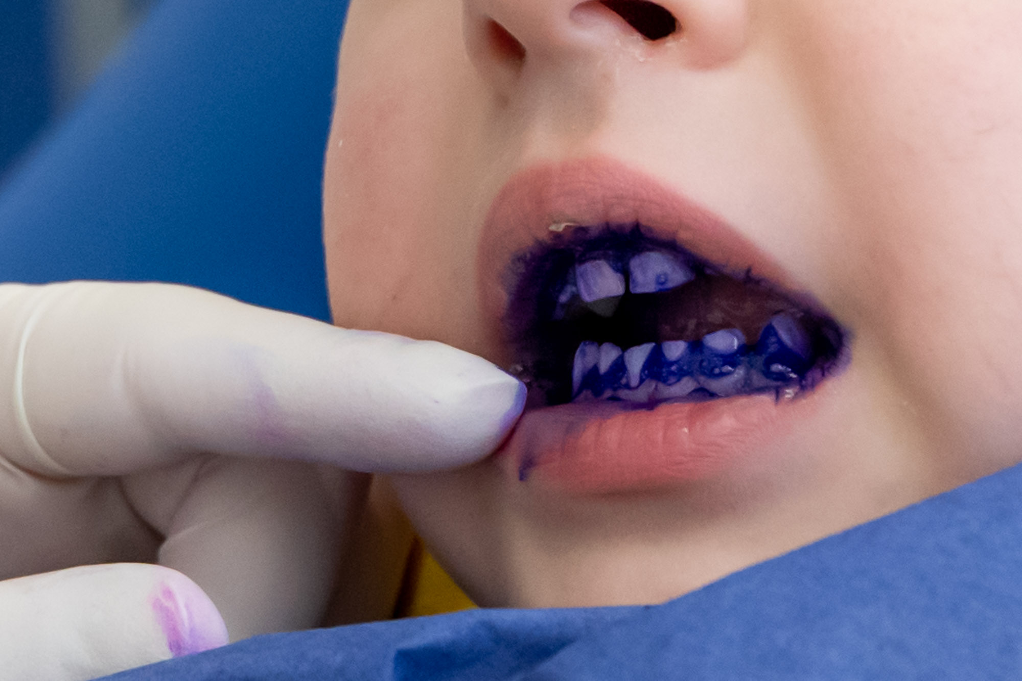 Färbemittel zum zeigen von vorhanden Zahnbelägen