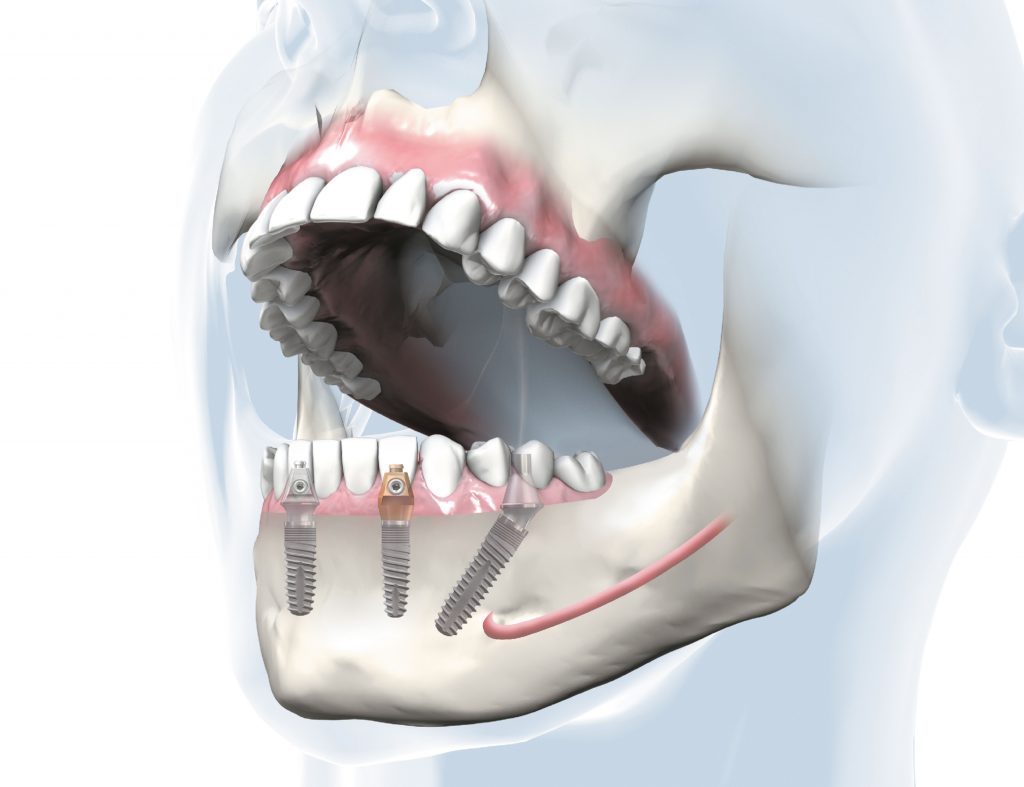 Darstellung Behandlungskonzept SKY fast & fixed im Unterkiefer