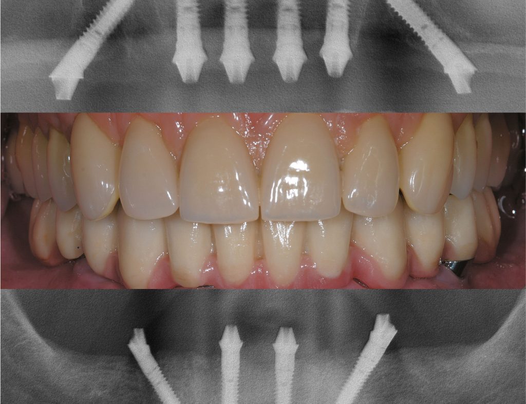 Darstellung der Implantate von Sky fast and fixed mit einem Röntgenbild